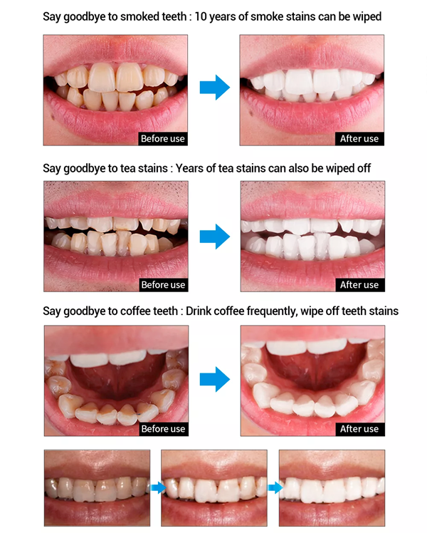 Before and after results of using LA PERCA teeth whitening essence